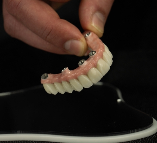 Bezzobu žokļu atjaunošana ar metodi “visi zobi uz 4 implantiem” – ārstēšanas priekšrocības