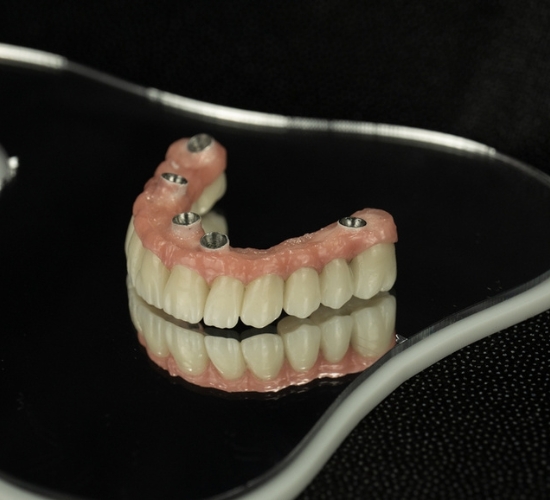 Bezzobu žokļu atjaunošana ar metodi “visi zobi uz 4 implantiem” – ārstēšanas priekšrocības