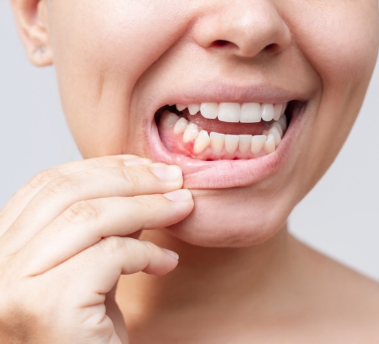 Periodonta slimības – izvairīšanās no ārstēšanas var izraisīt pat zobu zudumu