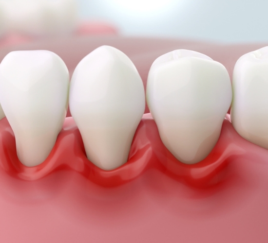 Periodonta slimības – izvairīšanās no ārstēšanas var izraisīt pat zobu zudumu