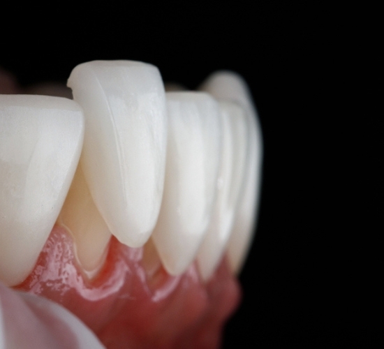 Zobu protēzes ar zobu finieriem vai estētiskajām plombām – kādas ir šo procedūru atšķirības?