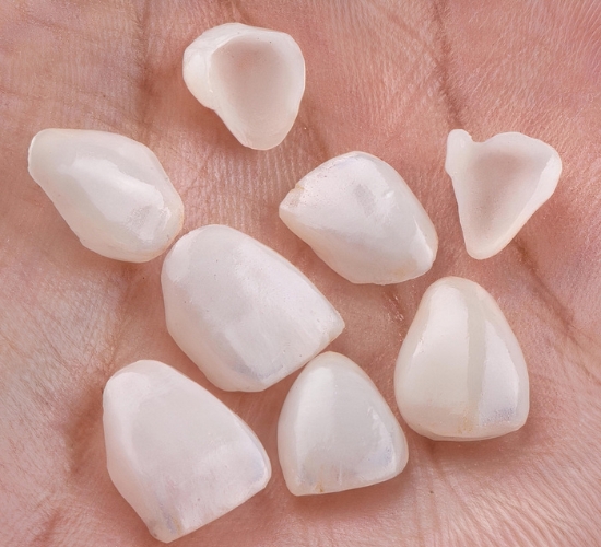 Zobu protēzes ar zobu finieriem vai estētiskajām plombām – kādas ir šo procedūru atšķirības?