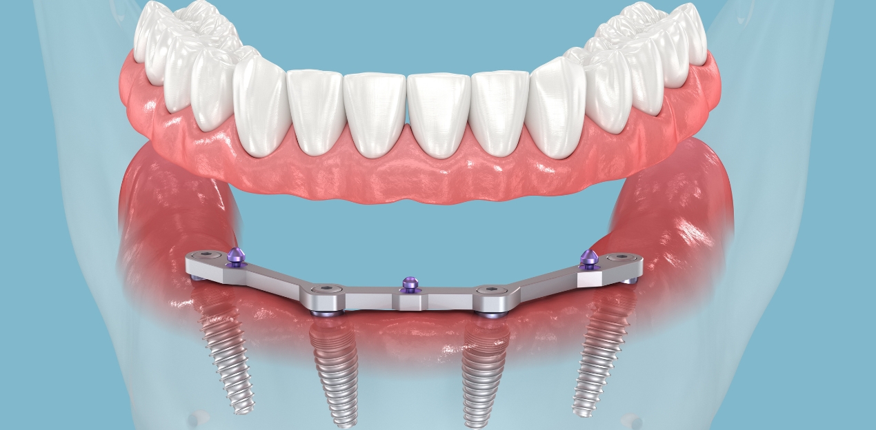 Bezzobu žokļu atjaunošana ar metodi “visi zobi uz 4 implantiem” – ārstēšanas priekšrocības