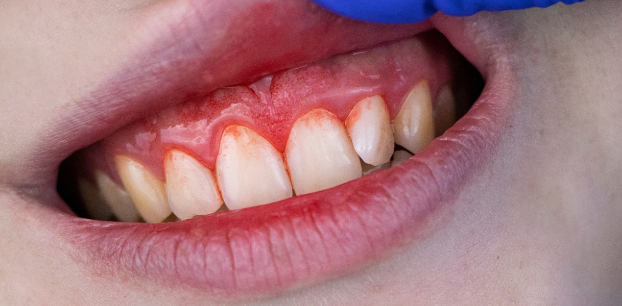 Periodonta slimības – izvairīšanās no ārstēšanas var izraisīt pat zobu zudumu