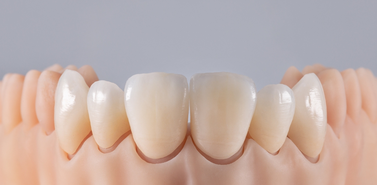 Zobu protēzes ar zobu finieriem vai estētiskajām plombām – kādas ir šo procedūru atšķirības?