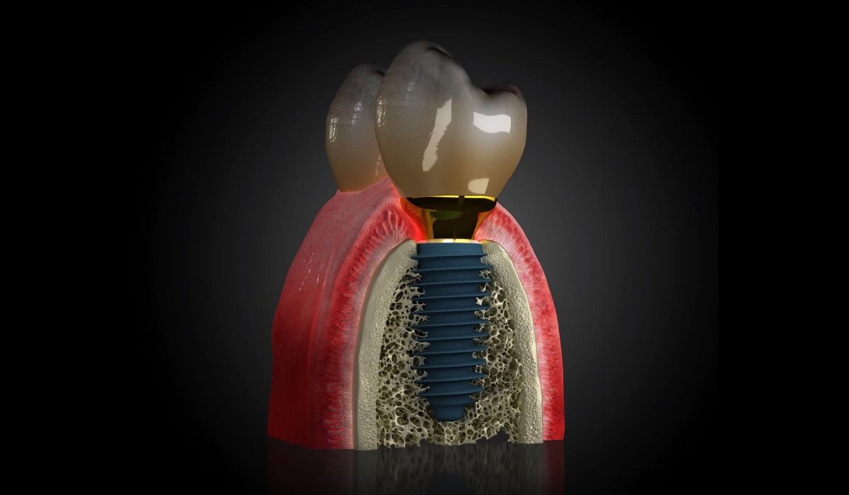 Kā darbojas zobu implanti?