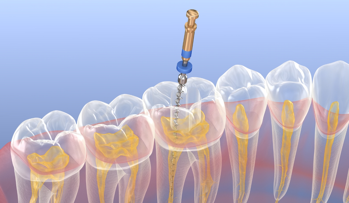Endodontiskā sakņu kanālu ārstēšana