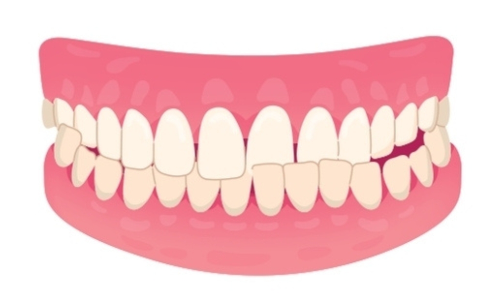 Vidējais iztaisnošanas gadījums
